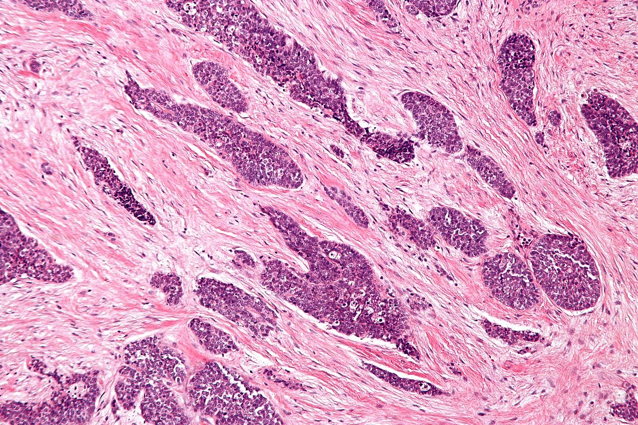 Micrograph of a desmoplastic small round cell tumor, showing the characteristic desmoplastic stroma and angulated nests of small round cells on H&E stain.[4]