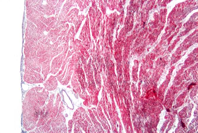 This is a photomicrograph of a trichrome-stained section from a heart with an acute myocardial infarction. Note that there is little fibrous connective tissue. It is too early for scar formation to have taken place in this acute lesion.