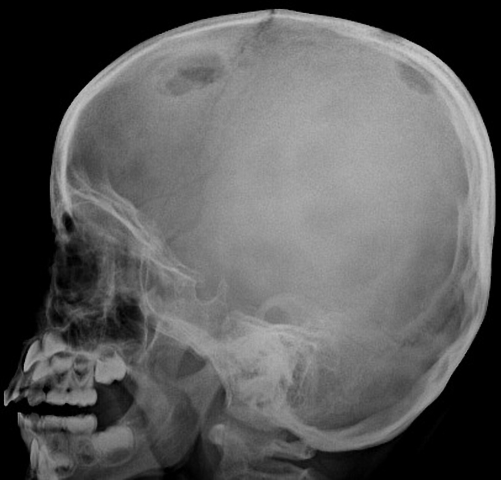 Langerhans cell histiocytosis punched-out lytic skull lesions