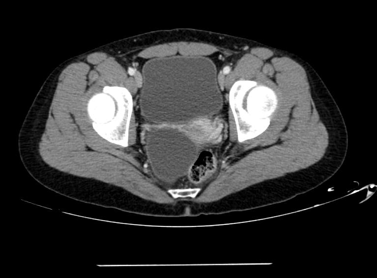 File:Ovarian cyst 101.jpg
