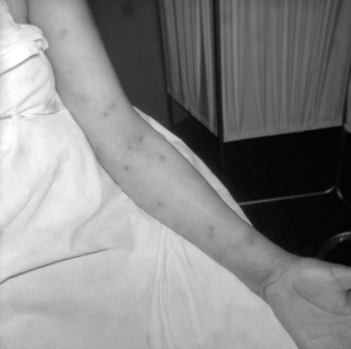 Photograph of secondary syphilitic papular rash on a patient’s left arm. A patient with a papular rash on the left arm that developed during secondary syphilis. The rash often appears as rough, red or reddish brown spots that can appear on palms of hands, soles of feet, the chest and back, or other parts of the body.