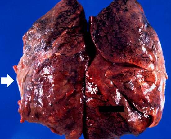 Radiation fibrosis 1.jpg