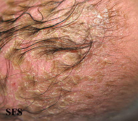 File:Seborrheic-dermatitis-images.jpg