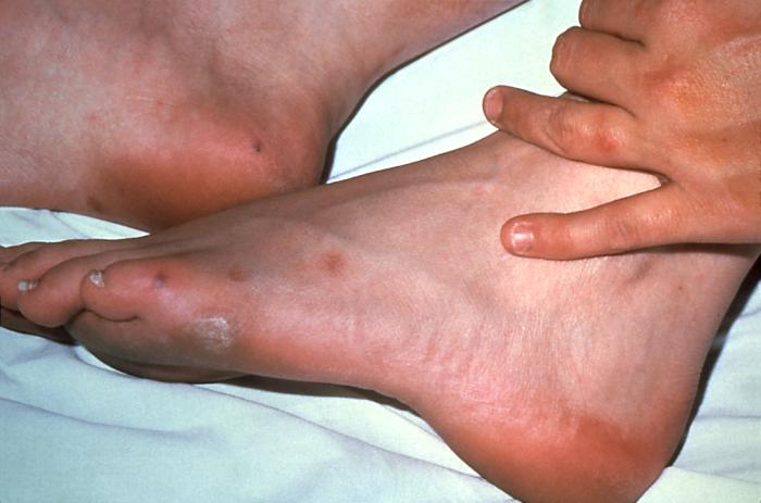 This patient presented with cutaneous foot lesions that were diagnosed as a disseminated gonococcal infection. Gonorrhea is the most frequently reported communicable disease in the U.S. Disseminated gonococcal infection is most often the cause of acute septic arthritis in sexually active adults, and the reason for most hospitalizations due to infective arthritis.Adapted from CDC