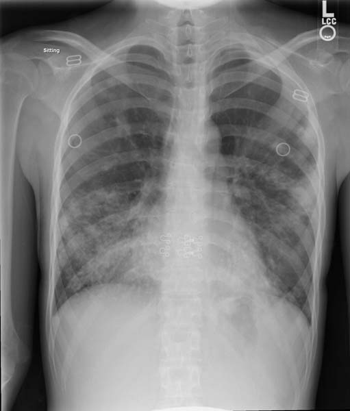 Chest x-ray: Disseminated Tuberculosis