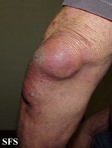 Ganglion cyst. Adapted from Dermatology Atlas.[2]