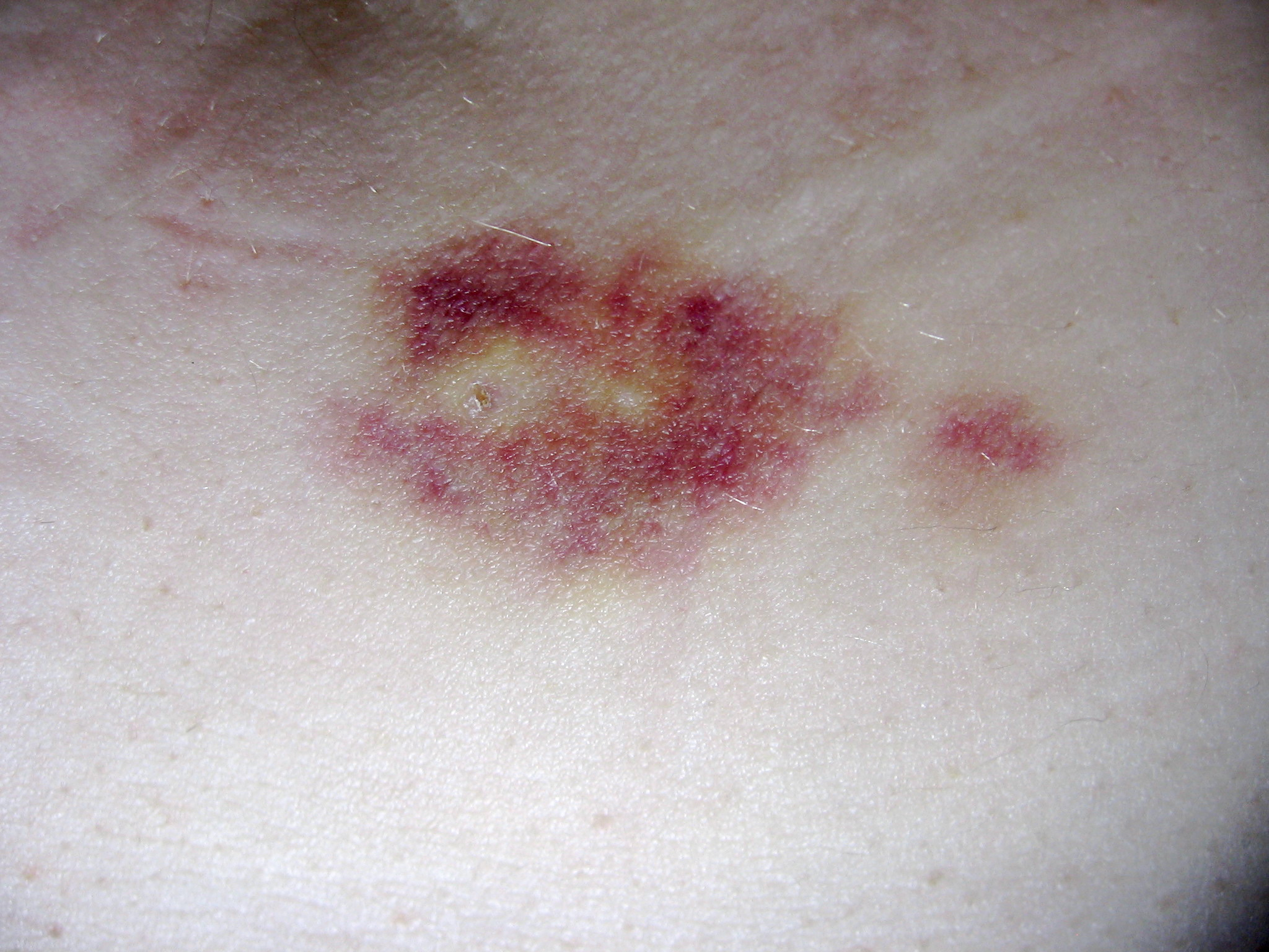 A typical injection site post-implant. The entry wound and pellet ejection bruise can clearly be seen here
