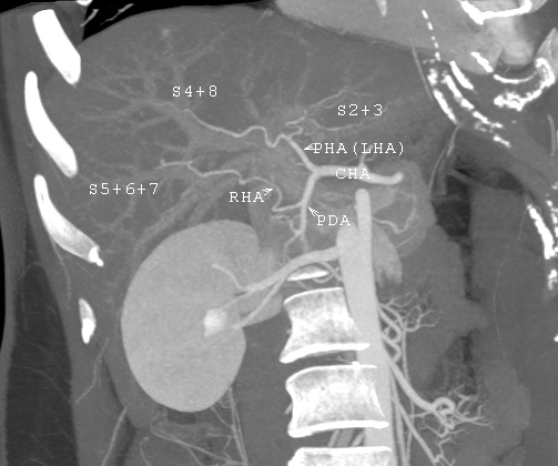 MDCT image. Arterial anatomy contraindicated for liver donation.