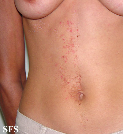 Linear Darier's disease. Adapted from Dermatology Atlas.[1]