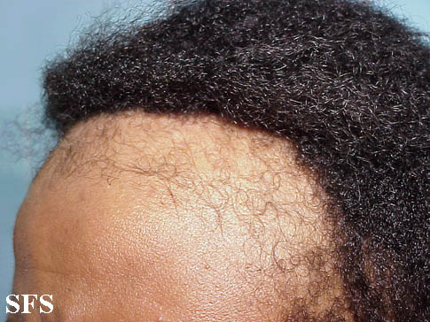 Traumatic alopecia. Adapted from Dermatology Atlas.[2]