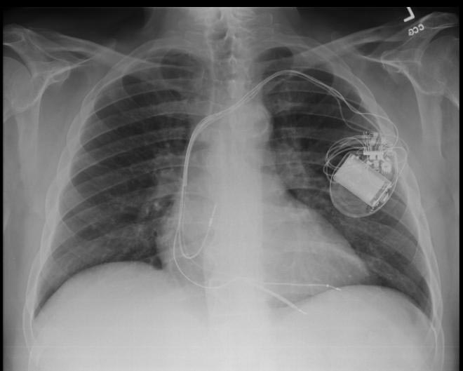 CXR showing Trilead cardiac pacer Image courtesy of RadsWiki and copylefted