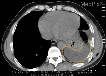 File:Webp.net-gifmaker hemothorax CT.gif