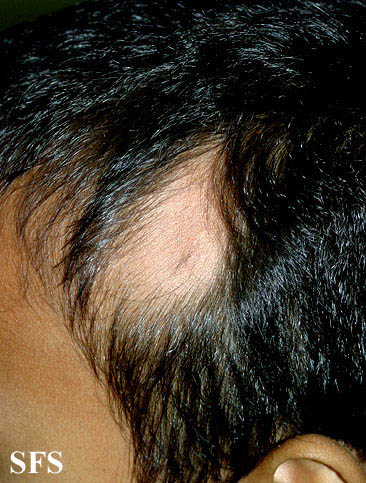 Alopecia triangular congenita01. Adapted from Dermatology Atlas.[6]