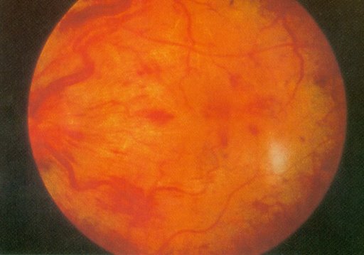 Central Retinal Vein Occlusion: HTN, DM, Leukemia (unilateral painless vision loss)[2]