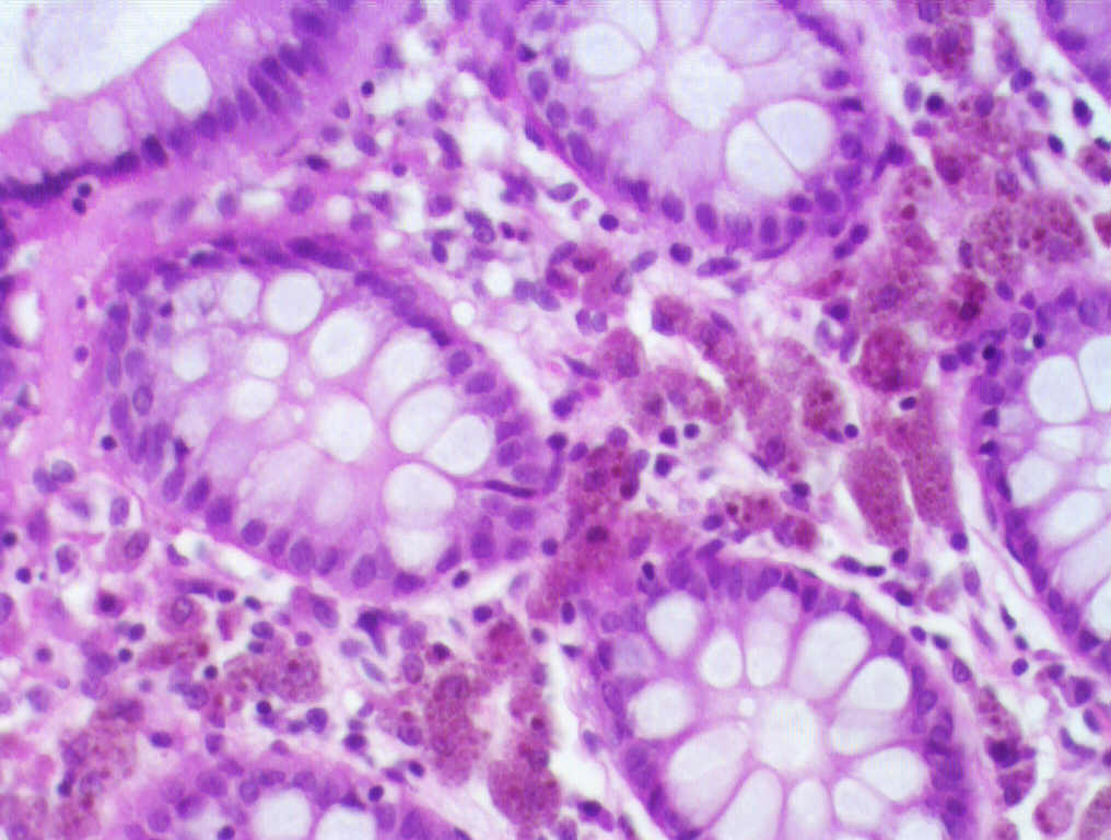 File:Colon melanosis. 1.jpg