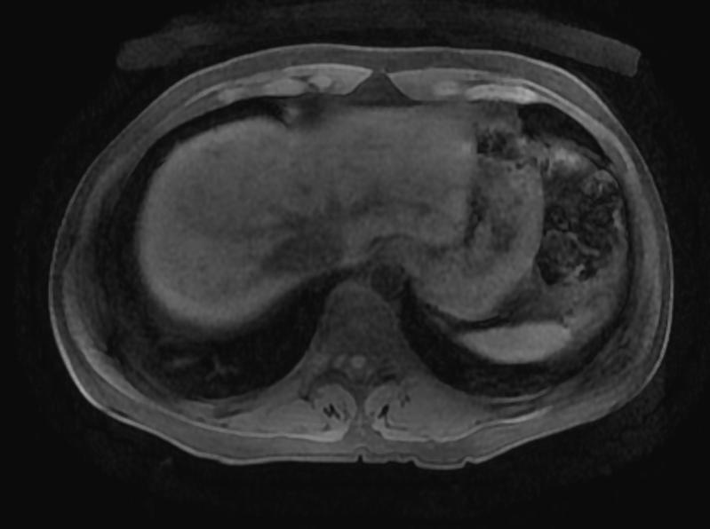 File:Focal nodular hyperplasia MRI 104.jpg