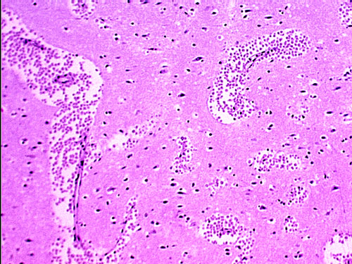 A section of the brain, stained with hematoxylin and eosin, of a PAM patient showing large clusters of Naegleria fowleri trophozoites. Cysts are not seen.
