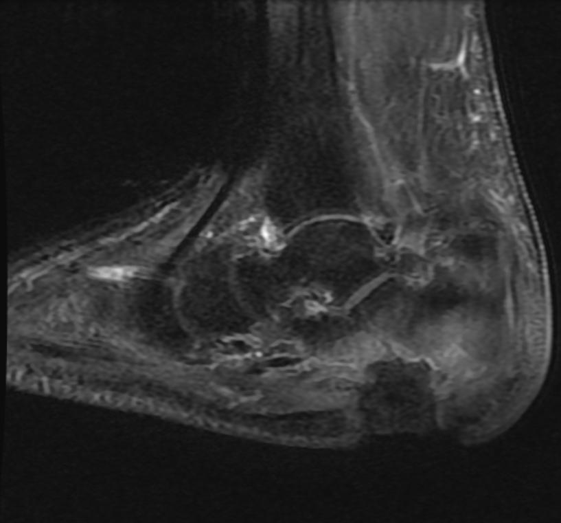 File:Osteomyelitis MRI 005.jpg