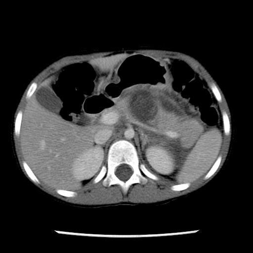 Computed Tomography: A patient with pancreatic transection and pseudocyst formation from motor vehicle accident