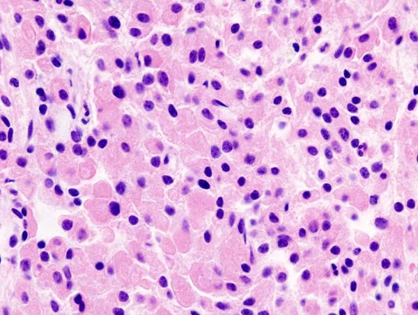 Histopathological image of pituitary adenoma with GH production. Acidophilic cell type. Hematoxylin & esoin stain.[7]