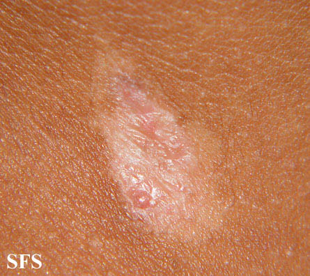 Aplasia Cutis Congenita. Adapted from Dermatology Atlas.<ref name="Dermatology Atlas">{{Cite