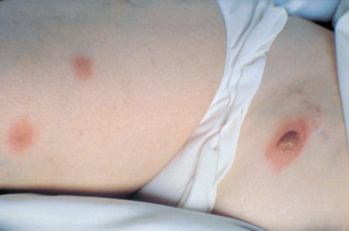 Nodular skin lesions of blastomycosis, one of which is a bullous lesion on top of a nodule. Aspiration of the bulla revealed yeast forms of Blastomyces dermatitidis. From Public Health Image Library (PHIL). [2]
