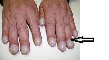 Clubbing:angle between the nail plate and proximal nail fold is greater than 180 degrees Source:Wikimedia commons [6]