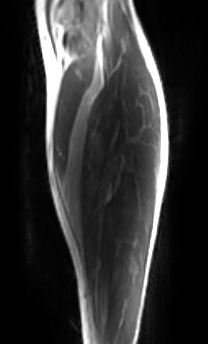 File:Plantaris rupture MRI 007.jpg