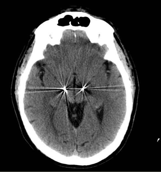 Subthalamic nucleus deep brain stimulators 003.jpg