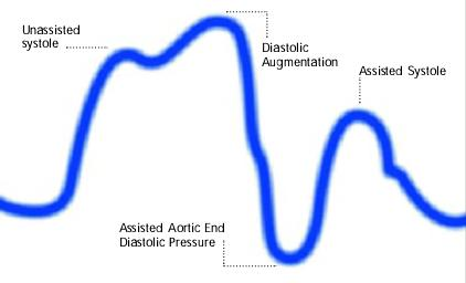 Inflation of the intra aortic balloon prior to aortic valve closure (Inflation of balloon prior to dicrotic notch. Diastolic augmentation encroaches onto systole)