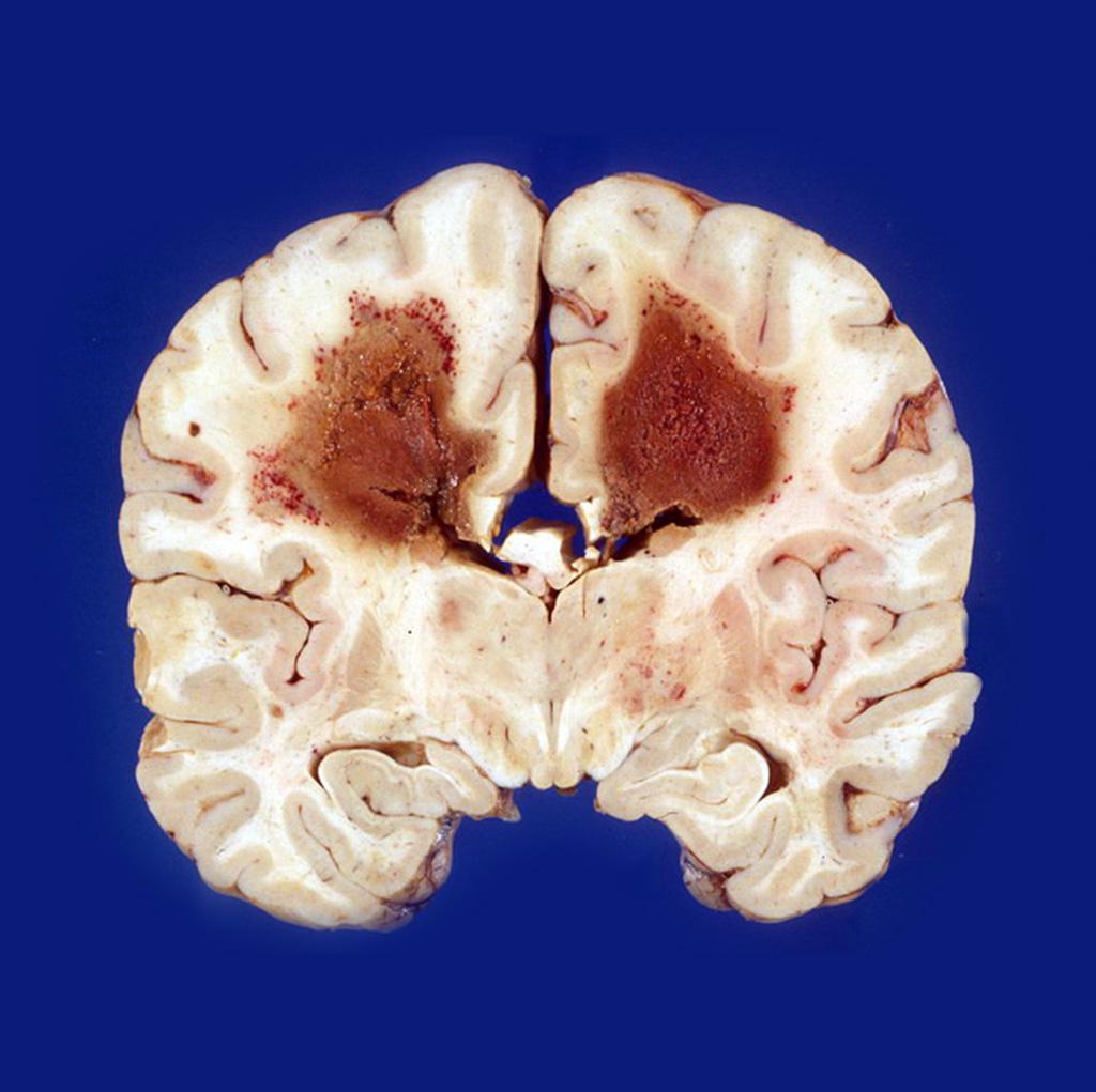 Gross pathological specimen primary central nervous system lymphoma in the brain parenchyma. This autopsy photograph shows involvement of cerebral hemispheres by a primary CNS lymphoma in an AIDS patient. It was a large B-cell lymphoma and the patient succumbed to it within 6 months of diagnosis.[5]