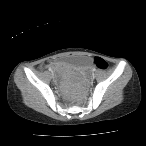 8 y/o female with right lower quadrant pain patient#2 Image courtesy of RadsWiki and copylefted