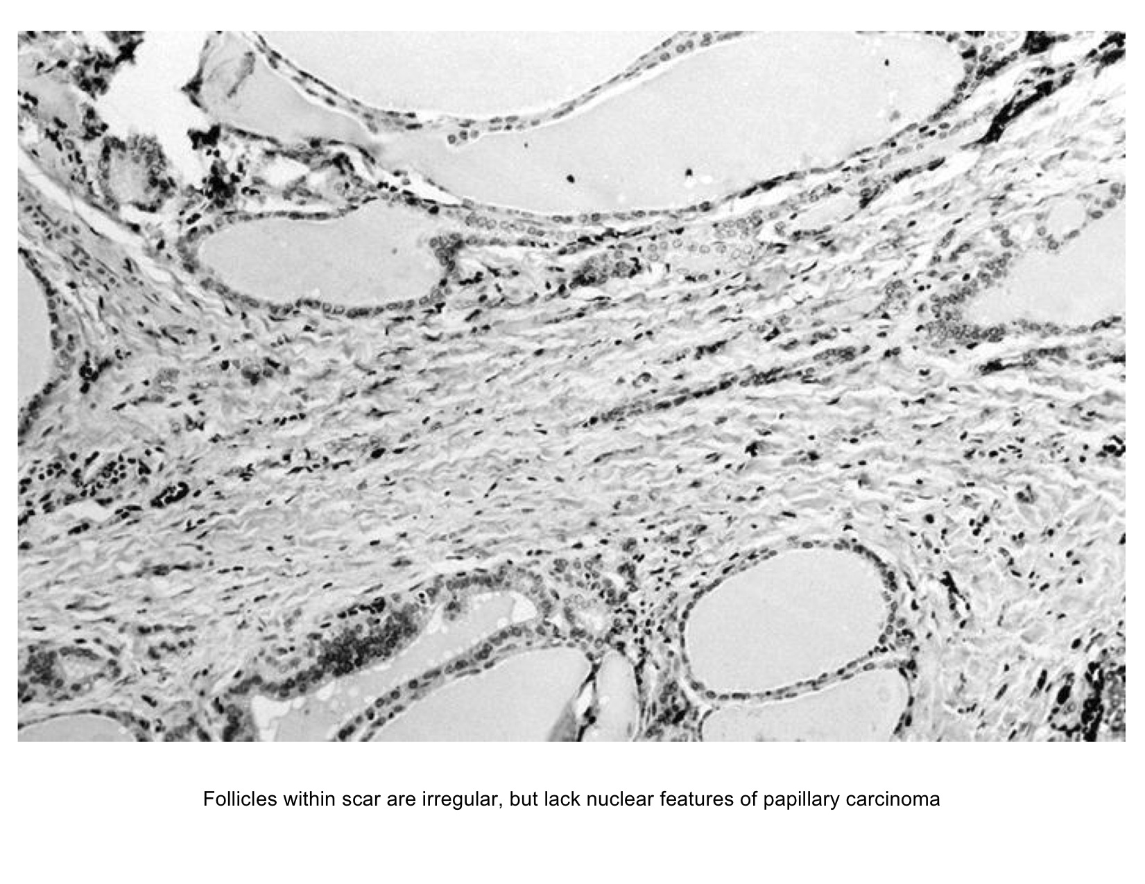 Fibrosis (Image courtesy of AFIP and PathologyOutlines.com; http://www.pathologyoutlines.com/topic/thyroidriedel.html )