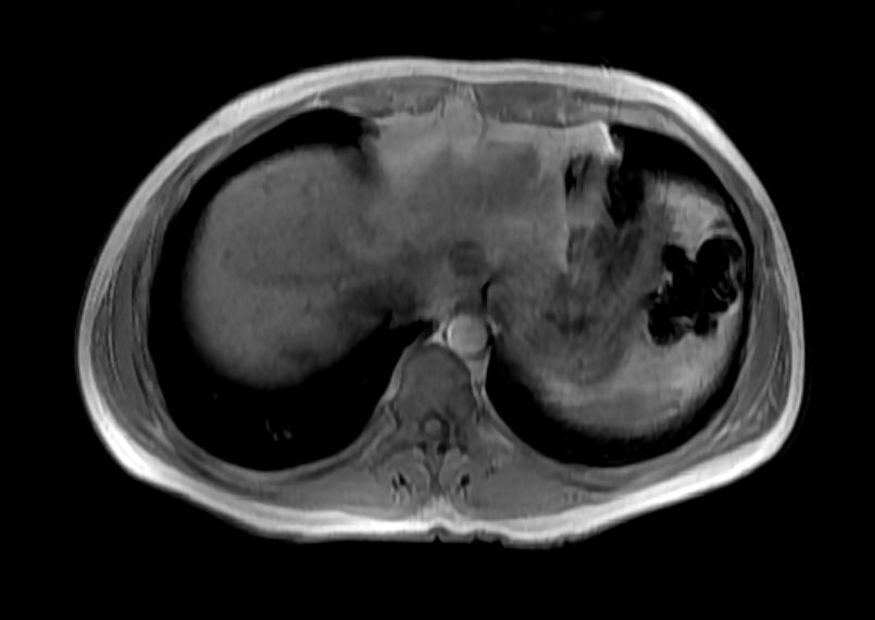 File:Focal nodular hyperplasia MRI 103.jpg