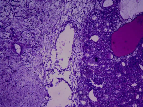 File:Struma ovarii Microscopic appearance of the resected tumor.jpg