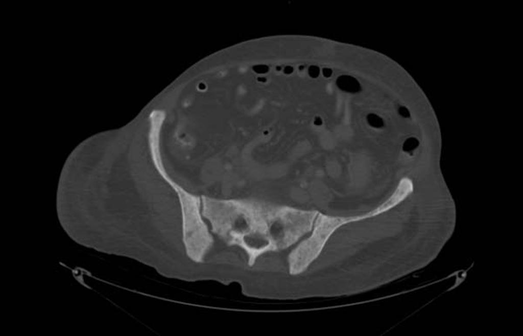 File:Ct image of myelofibrosis 1.jpg
