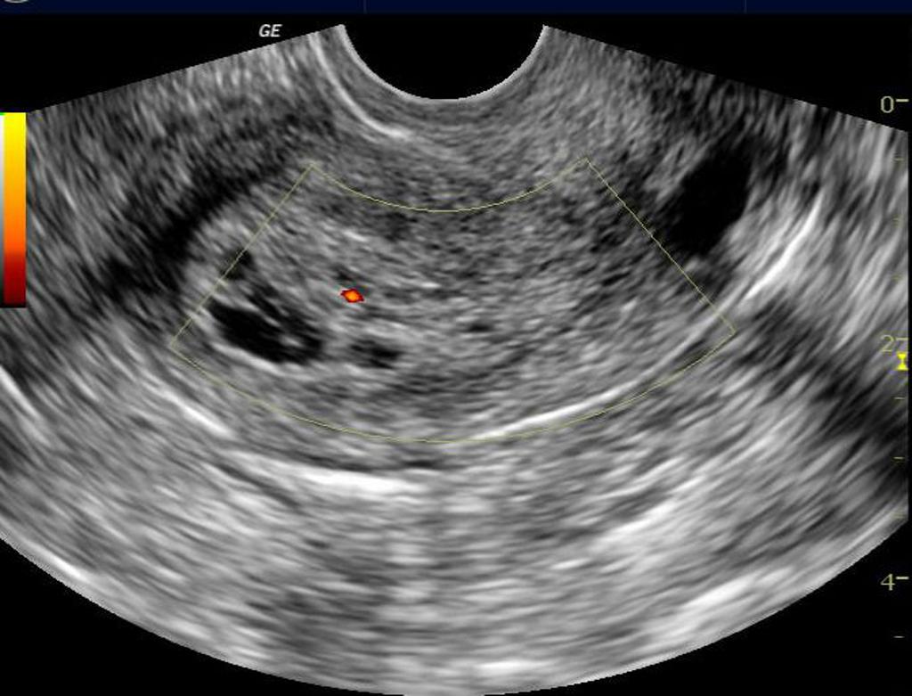 File:Endometrial-hyperplasia (4).jpg