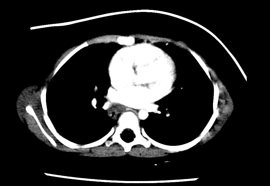 File:Esophageal leiomyomatosis CT 001.jpg