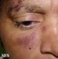 Lupus Erythematosus-Subacute Cutaneous Lupus Erythematosus. Adapted from Dermatology Atlas.[4]