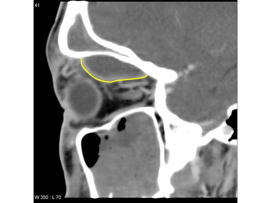 Orbital cellulitis with peripheral abscess displacing the globe on sagittal plane CT scan