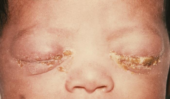 This was a newborn with gonococcal ophthalmia neonatorum caused by a maternally transmitted gonococcal infection. Unless preventative measures are taken, it is estimated that gonococcal ophthalmia neonatorum will develop in 28% of infants born to women with gonorrhea. It affects the corneal epithelium causing microbial keratitis, ulceration and perforation.Adapted from CDC
