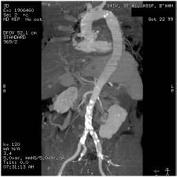 File:Renal artery stenosis 043.jpg
