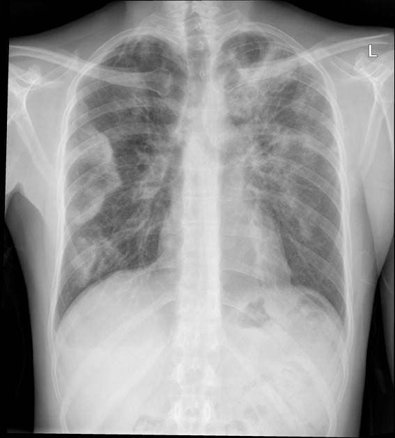 Chronic eosinophilic pneumonia, source: Case courtesy of Dr Henry Knipe, Radiopaedia.org, rID: 39331
