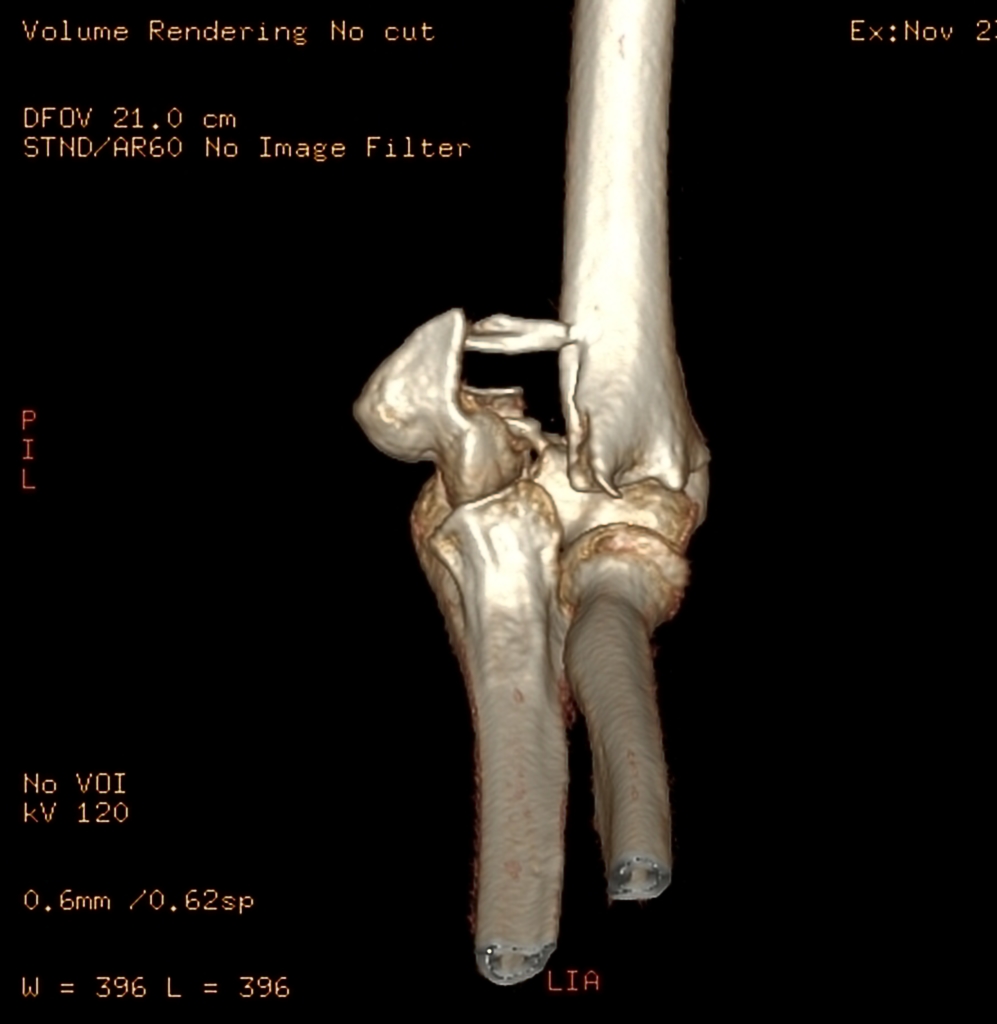 File:Displaced-t-condylar-and-supracondylar-fracture-of-the-distal-humerus (7).jpg