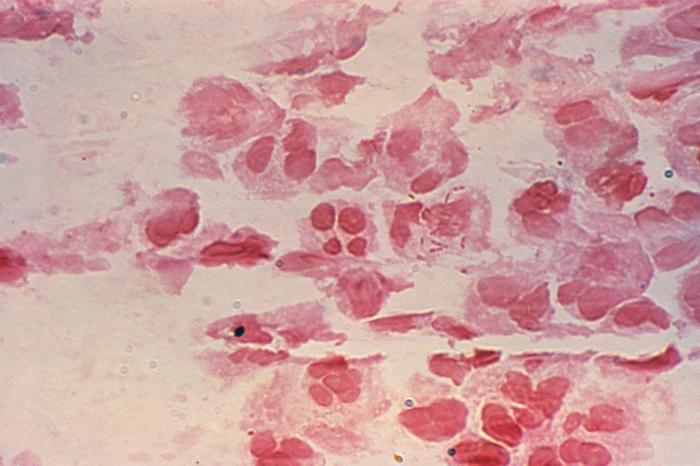 Urethral discharge for Neisseria gonorrhea revealed Gram-negative intracellular rods, NOT diplococci. From Public Health Image Library (PHIL). [6]