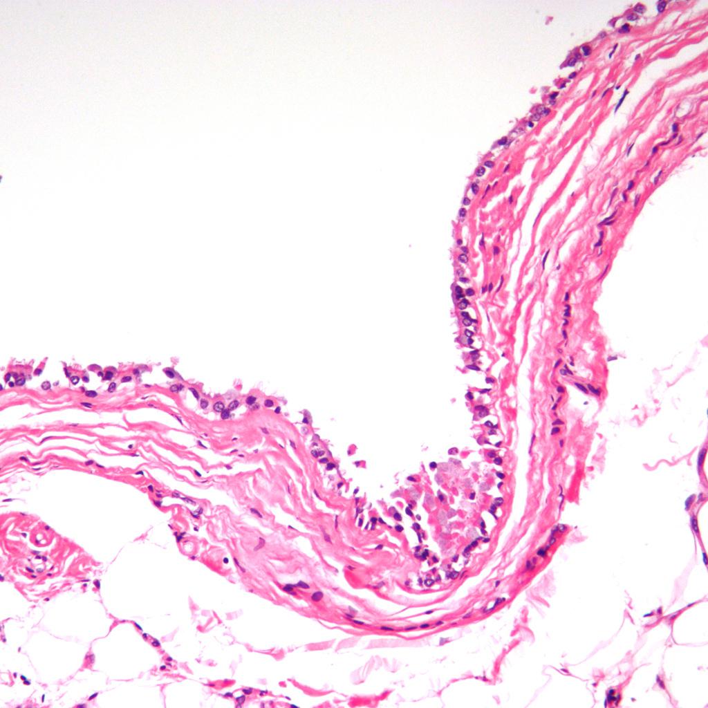 File:Histologic iamge of bronchogenic cyst.jpg