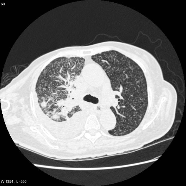 File:Miliary Tuberculosis CT 2.jpg