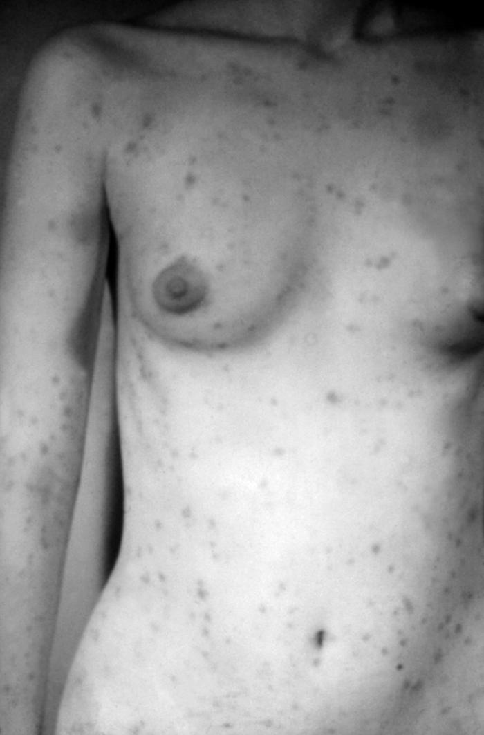 A photograph of a secondary syphilitic papulosquamous rash seen on the torso and upper body. This patient had an extensive papulosquamous rash that developed during secondary syphilis. The rash often appears as rough, red or reddish brown spots that can appear on palms of hands, soles of feet, the chest and back, or other parts of the body.