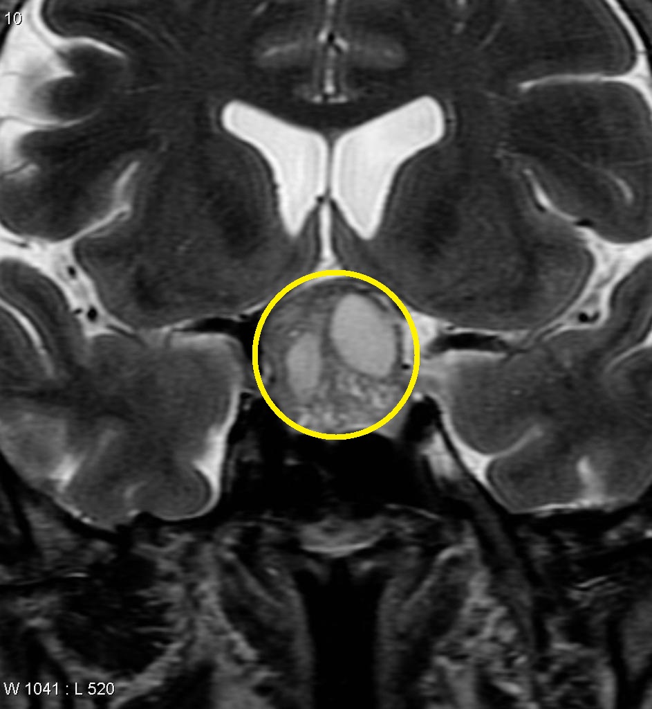 Pituitary non-functioning macroadenoma - Case courtesy of A.Prof Frank Gaillard, <a href="https://radiopaedia.org/">Radiopaedia.org</a>. From the case <a href="https://radiopaedia.org/cases/5562">rID: 5562</a>