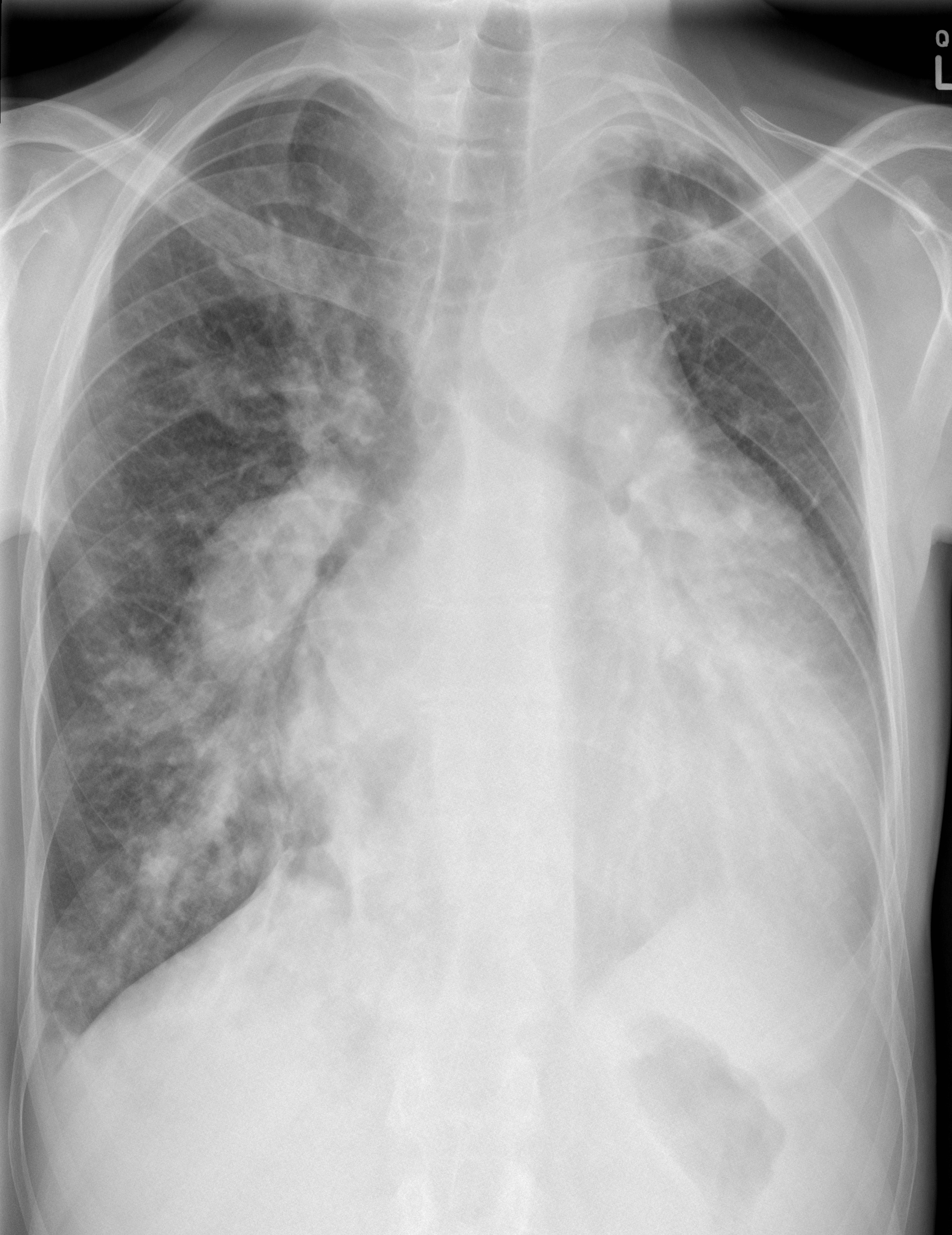 File:Unilateral-pulmonary-oedema-blalock-taussig-shunt-in-pulmonary-atresia-with-ventricular-septal-defect-1.jpg